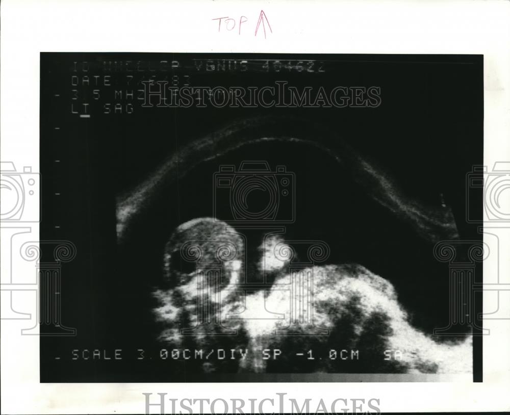 1984 Press Photo Fetus has intestinal blockage causing complications - Historic Images