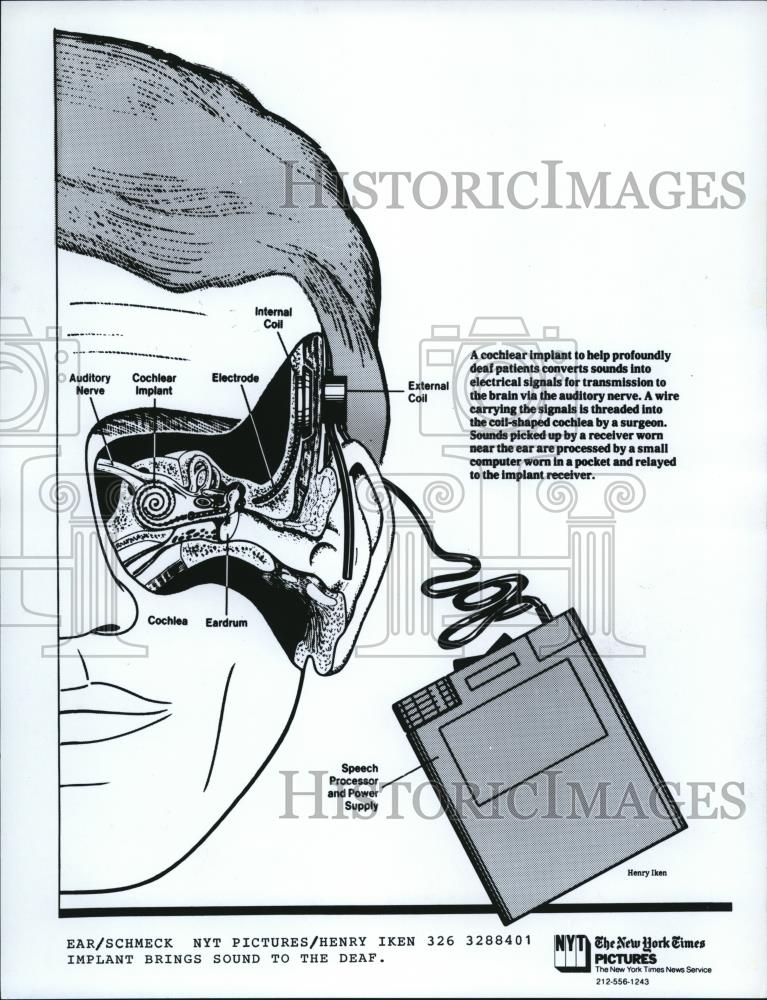 1984 Press Photo Drawing of Cochlear Implants for Ears - Historic Images