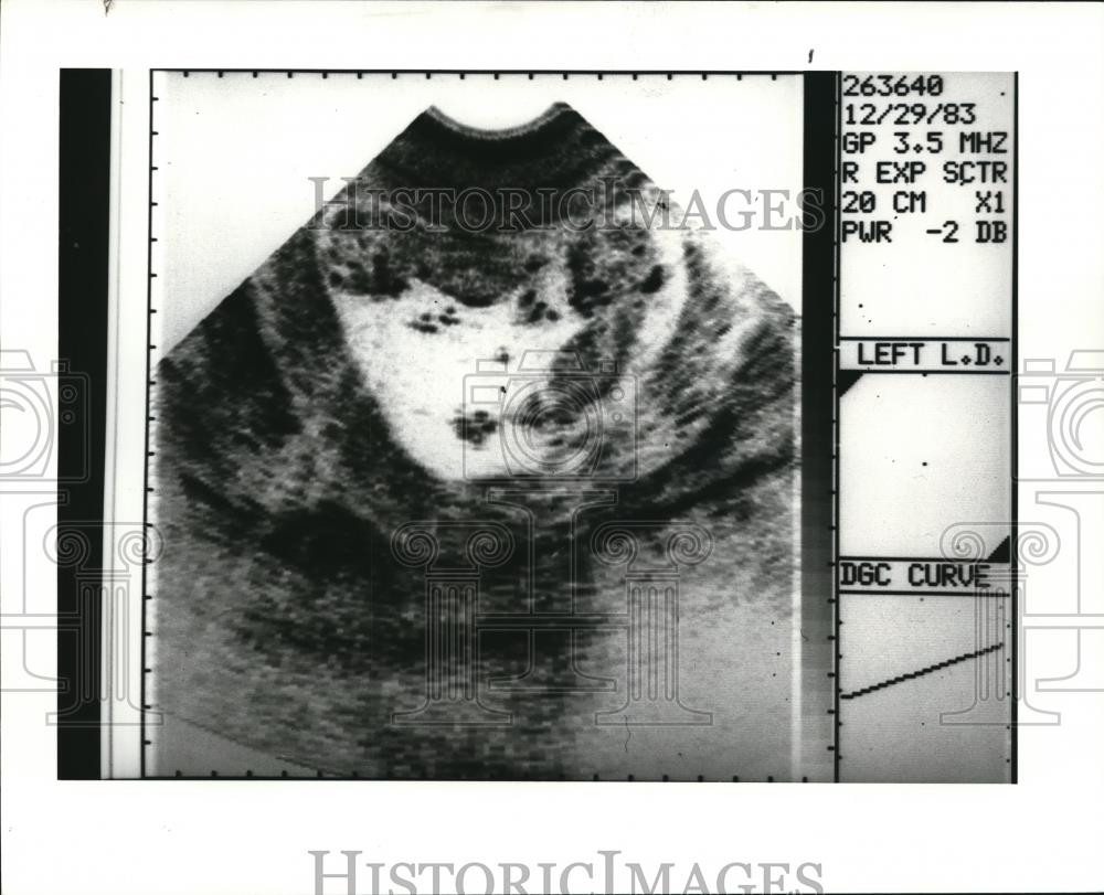 1983 Press Photo Ultrasound confirming this mom carries twins - Historic Images