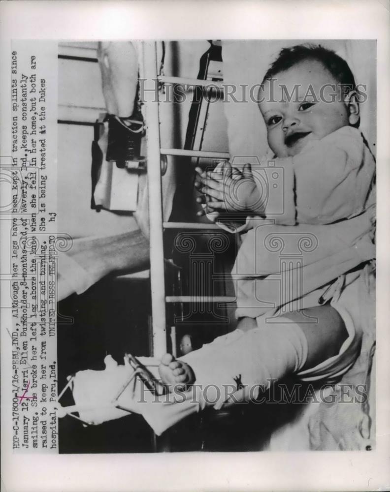 1953 Press Photo Jerri Ellen Burkholder broker her left leg above the knee - Historic Images