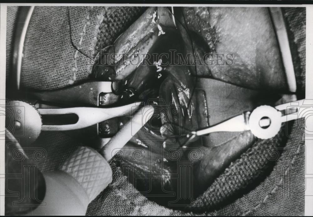 1967 Press Photo Cataract Eye Operation - Historic Images