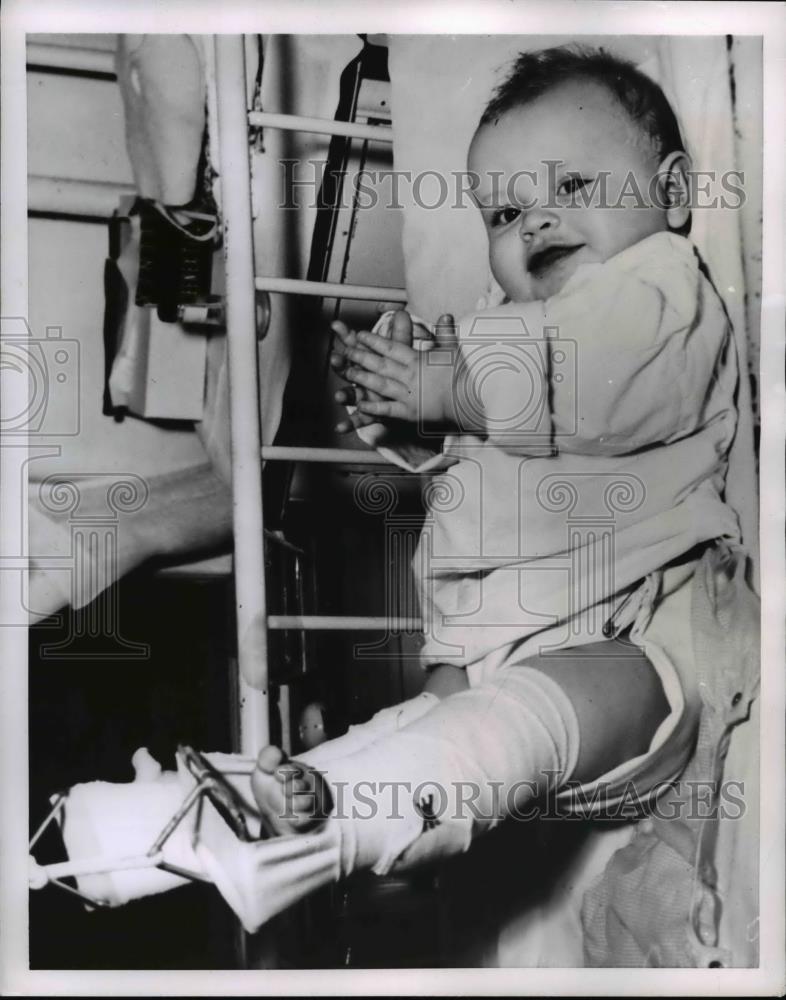 1953 Press Photo Jerri Ellen Burkholder broker her left leg above the knee - Historic Images