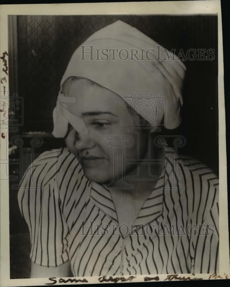 1939 Press Photo Thelma Restvedt, with her right eye injured - nee31955 - Historic Images