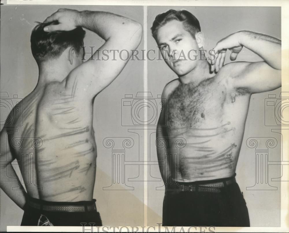 1941 Press Photo Max Caldwell shows welts given by Hilda Rhodes &amp; Aldythea Keith - Historic Images