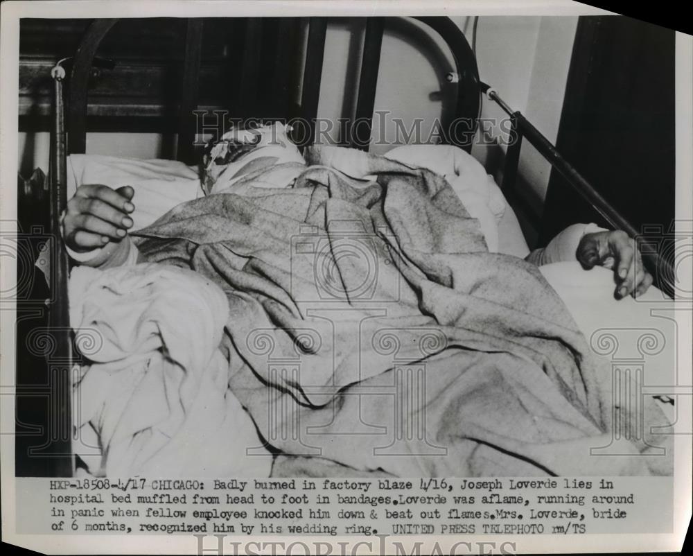 1953 Press Photo Joseph Loverde badly burns in Factory Blaze in Chicago. - Historic Images