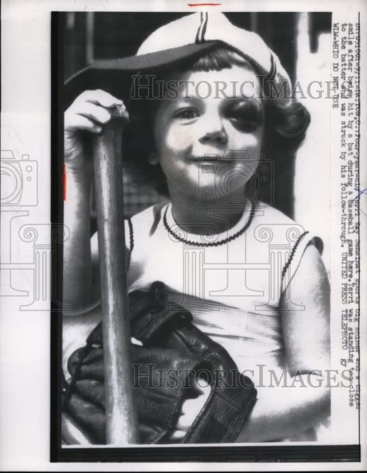 1957 Press Photo Terri Kay Schainat smiling broadly a sporting a shiner - Historic Images