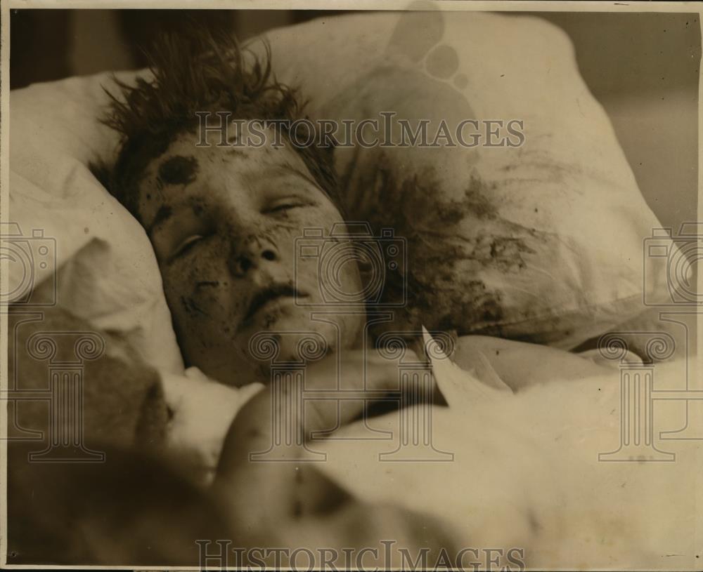 1927 Press Photo 10=year-old Don Grifith Santa Rosa Infirmary Tornado Victim - Historic Images