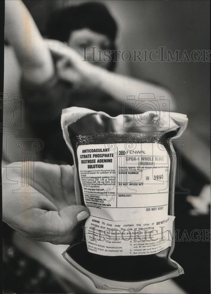 1980 Press Photo Anticoagulant Citrate Phosphate Dextrose Adenine Solution - Historic Images