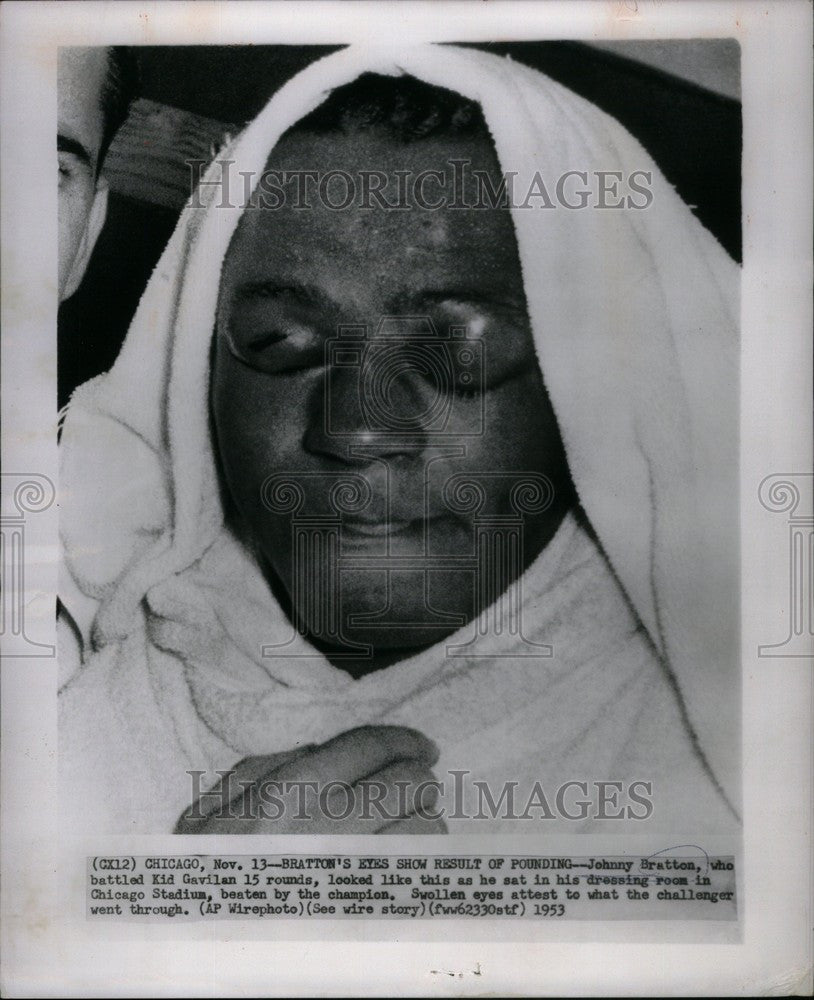 1953 Press Photo BRATTON&#39;S EYES SHOW RESULT OF POUNDING - Historic Images