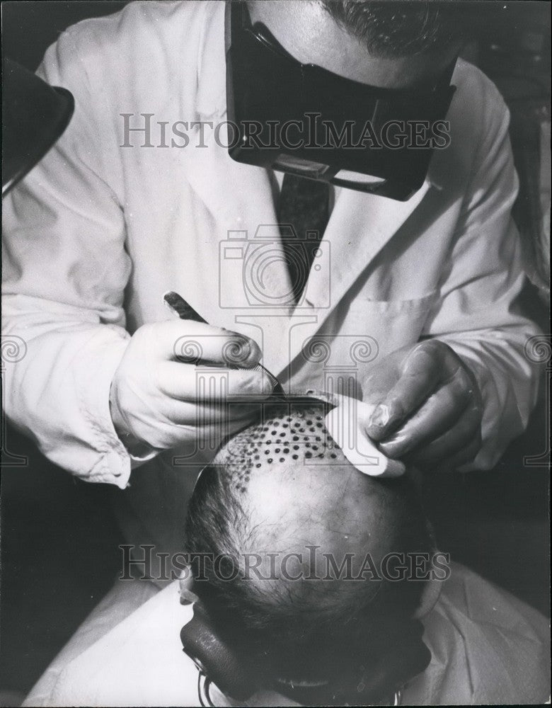 Press Photo Hair Transplantation - KSB41509-Historic Images