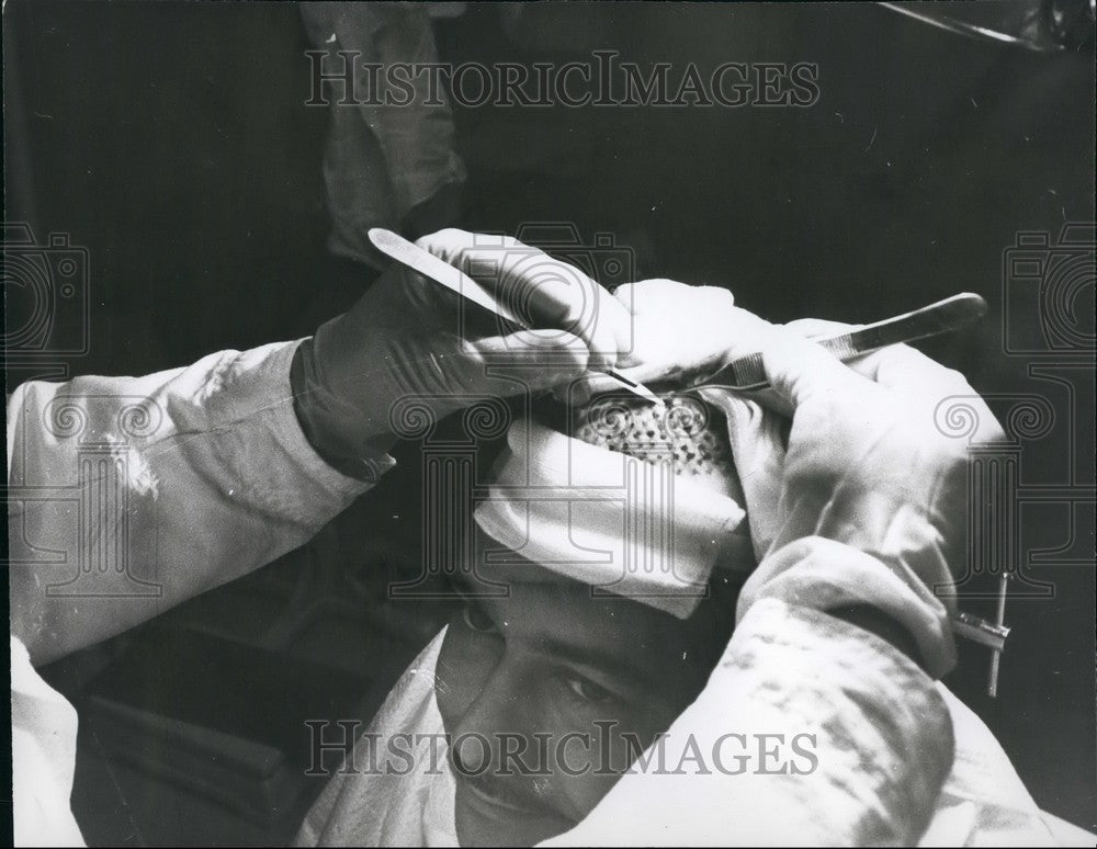 Press Photo hair plugs transplanted back patients head top - Historic Images
