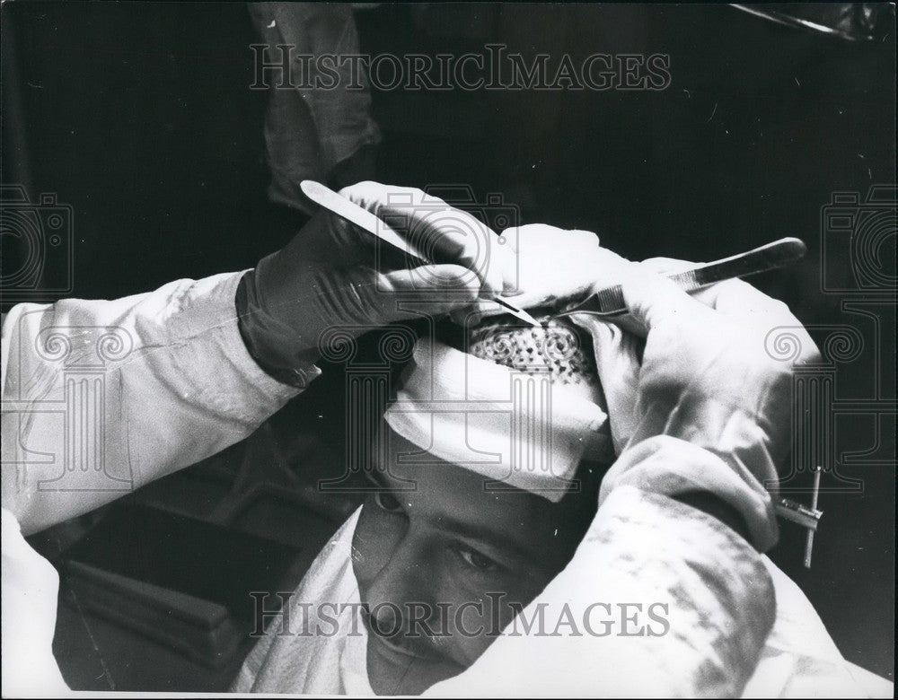 Press Photo hair transplant procedure - KSB47319-Historic Images