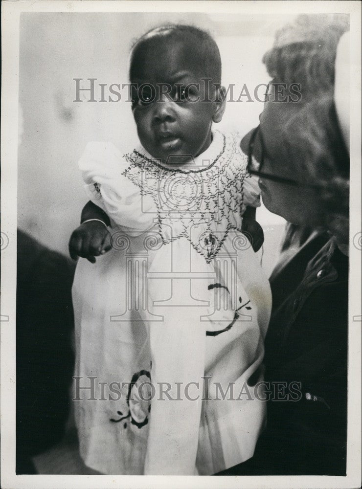 Press Photo Boko ,the Surviving Siamese Twin - Historic Images
