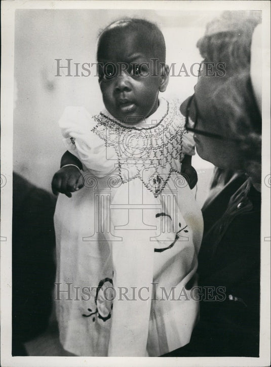 Press Photo Boko ,the Surviving Siamese Twin - Historic Images