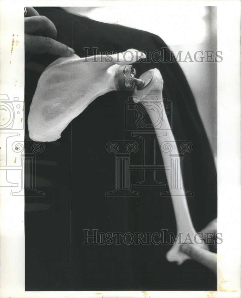 1974 Shoulder Artificial Bone Joint Develop - Historic Images