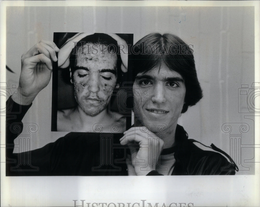 1982 Ken Iscra acne drug Dr Scott Glazer-Historic Images