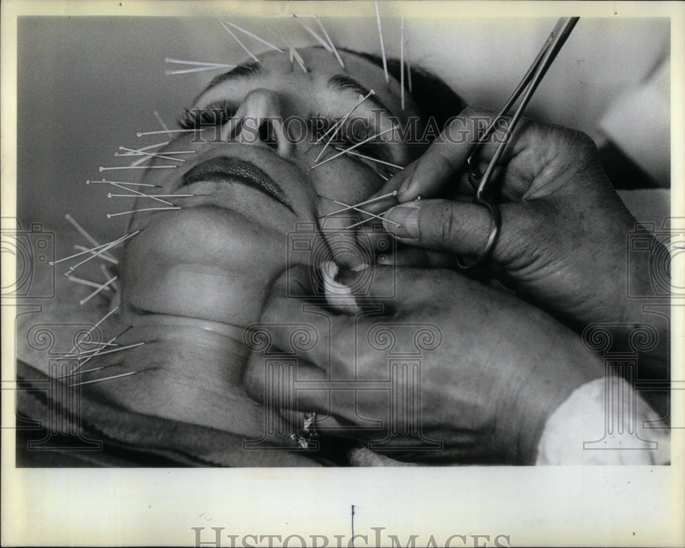 1982, Sally Ryter Surgical Face Acpuncture - RRU95945 - Historic Images