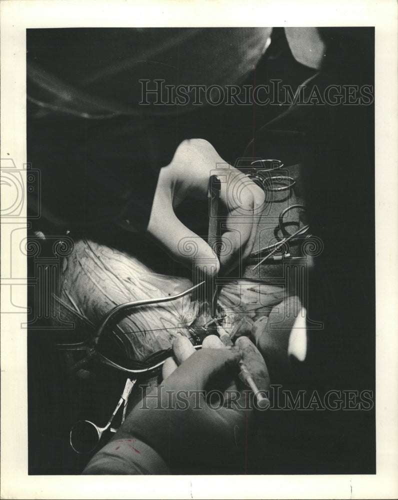 1978 Press Photo Dr John Mullan surgery Brain research - RRW48213 - Historic Images