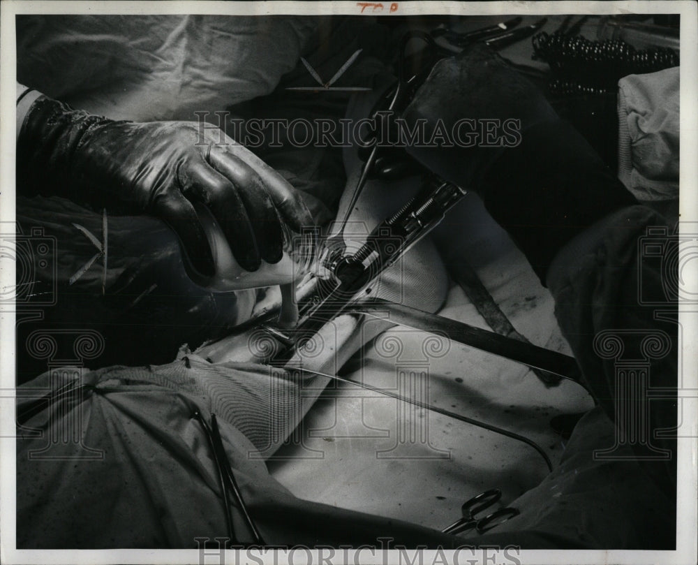 1959 Press Photo Performing bone surgery. - RRW87755 - Historic Images