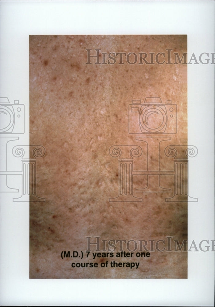 Press Photo Acne Disease 7 years after 1 therapy - RRW98531 - Historic Images