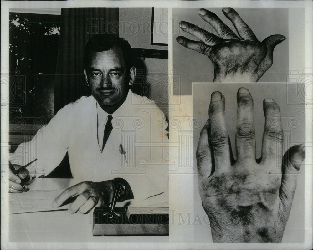 1972 Dr. Alfred B. Swanson Arthritis - Historic Images