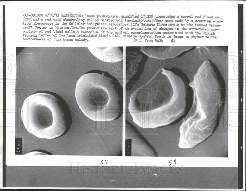1972 Press Photo magnified photo red blood cell Sickle - Historic Images