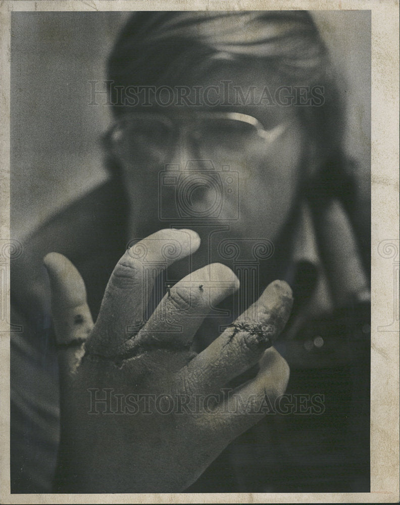 1976 Press Photo John Clarke Four Fingers Sewn Injured - Historic Images