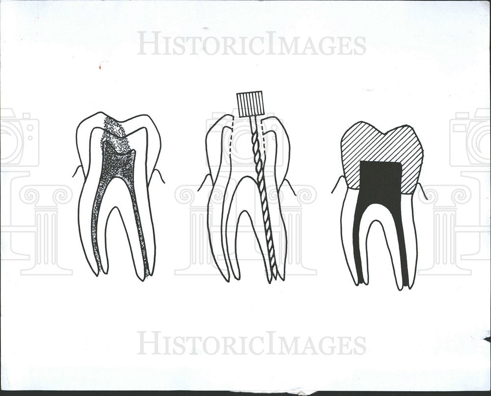1976 Press Photo diagram teeth - Historic Images