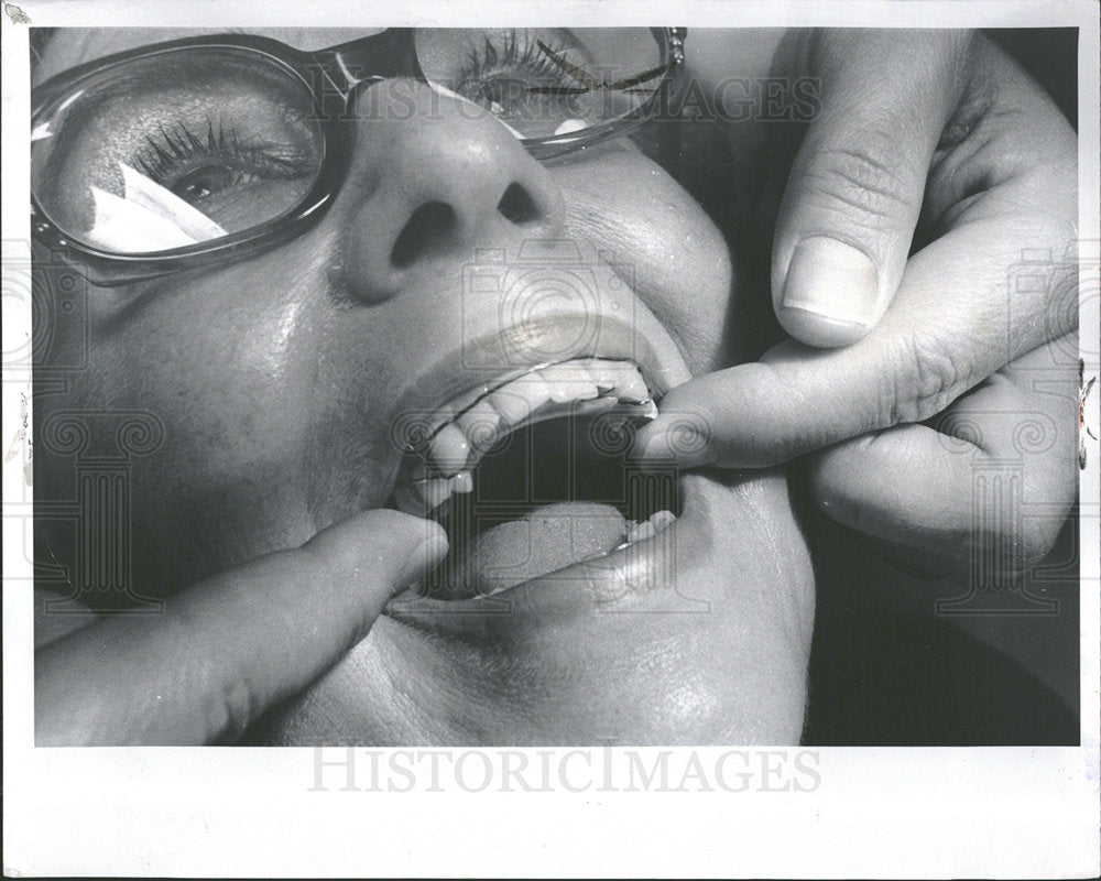 1975 Press Photo Close-Up Night Guard Grinding Teeth - Historic Images