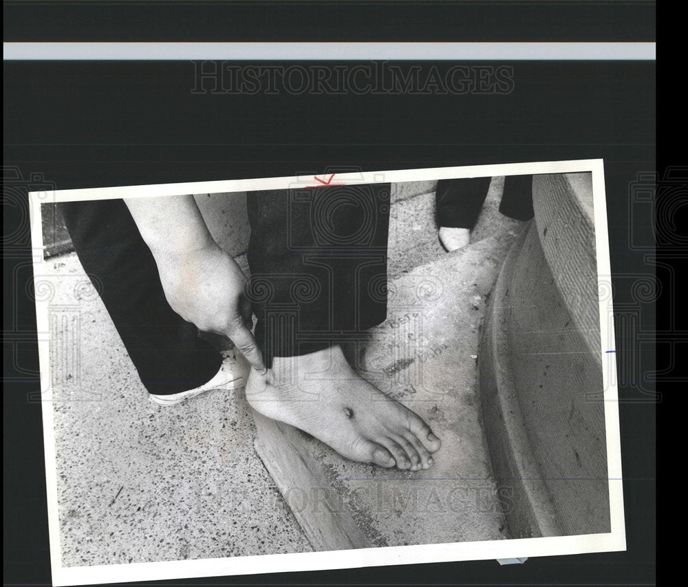 1982 Press Photo Two Bullet Holes in Victim's Foot - Historic Images