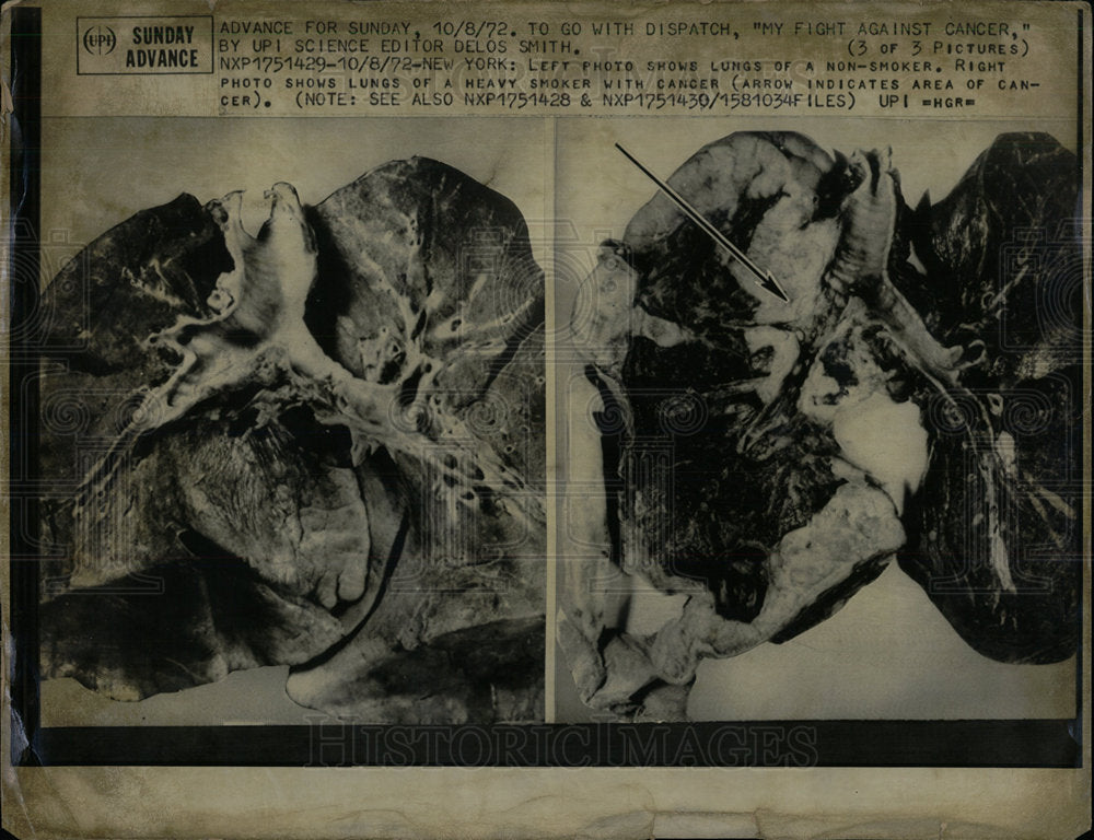 1972 Press Photo Lungs of Non-Smoker & Smoker. - Historic Images
