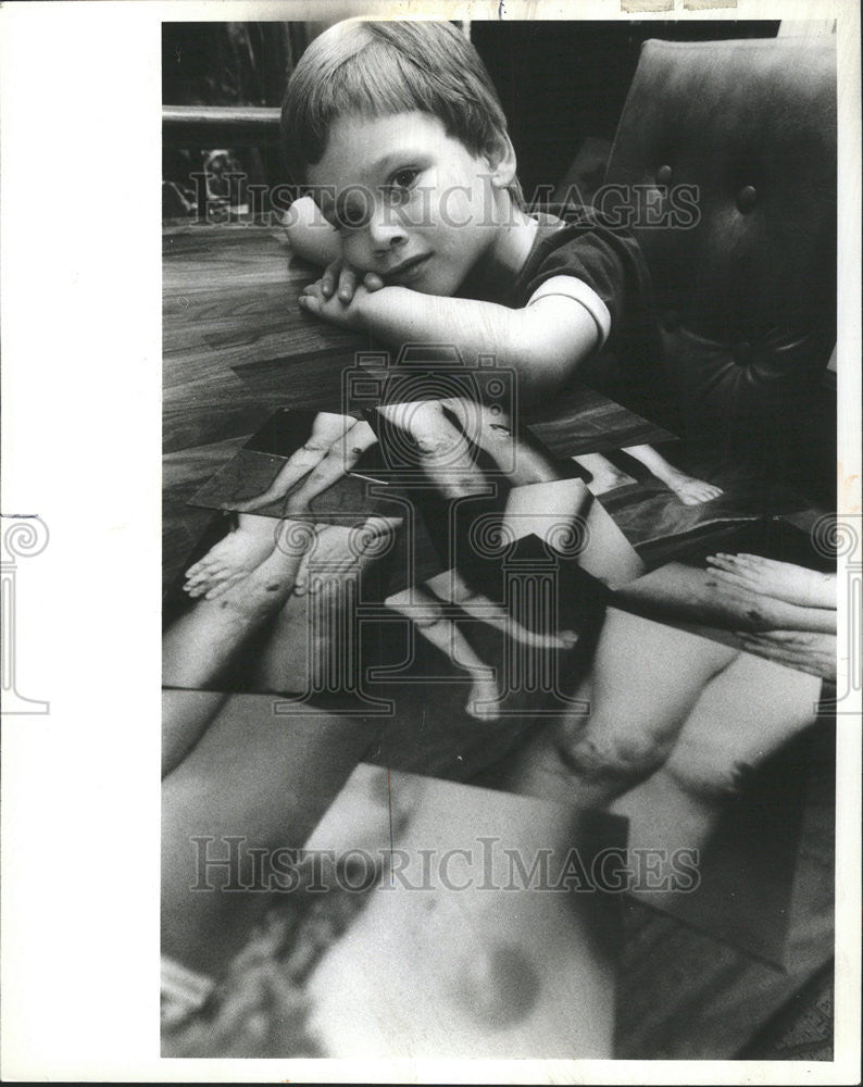 1982 Press Photo Andy Binkowski Naperville Illinois Skin Disease Patient - Historic Images