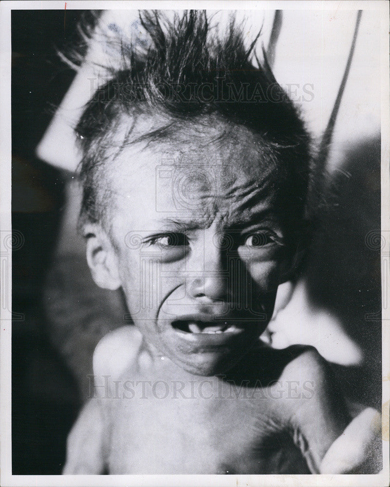 1967 Press Photo Indian boy treated for malnutrition - Historic Images