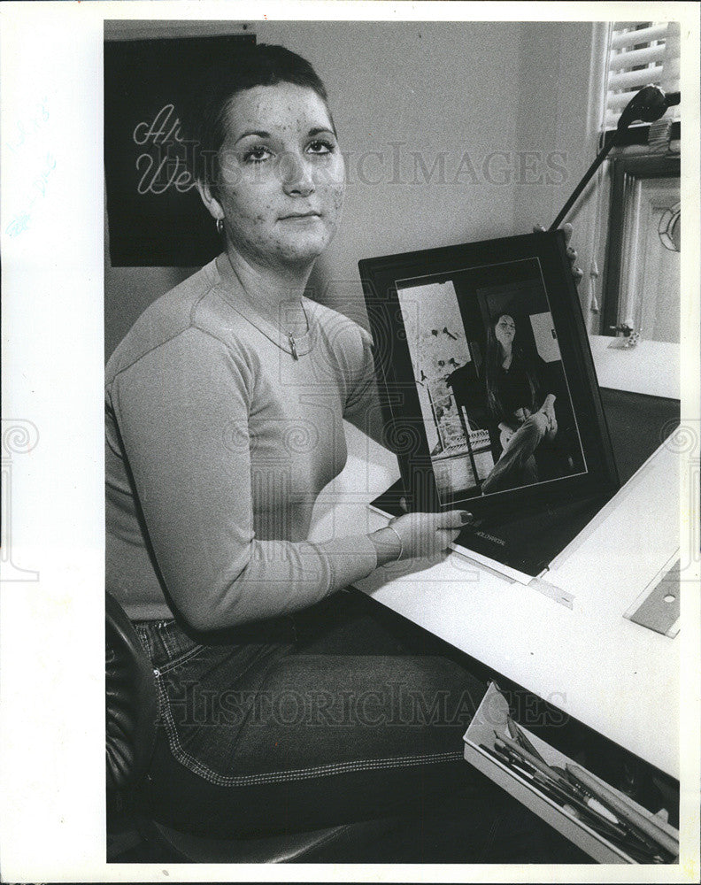 1982 Press Photo Cancer Patient Janice Meehan After Brain Tumor Treatment - Historic Images