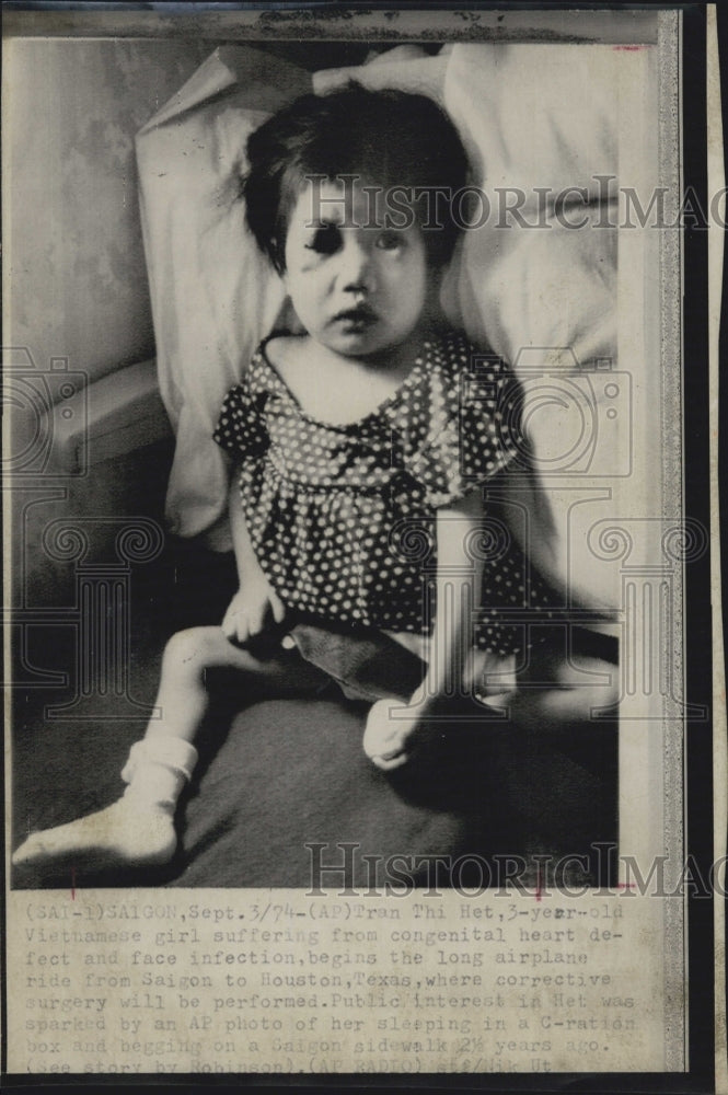 1974 Tran Thi Het 3 years old corrective surgery face infection - Historic Images