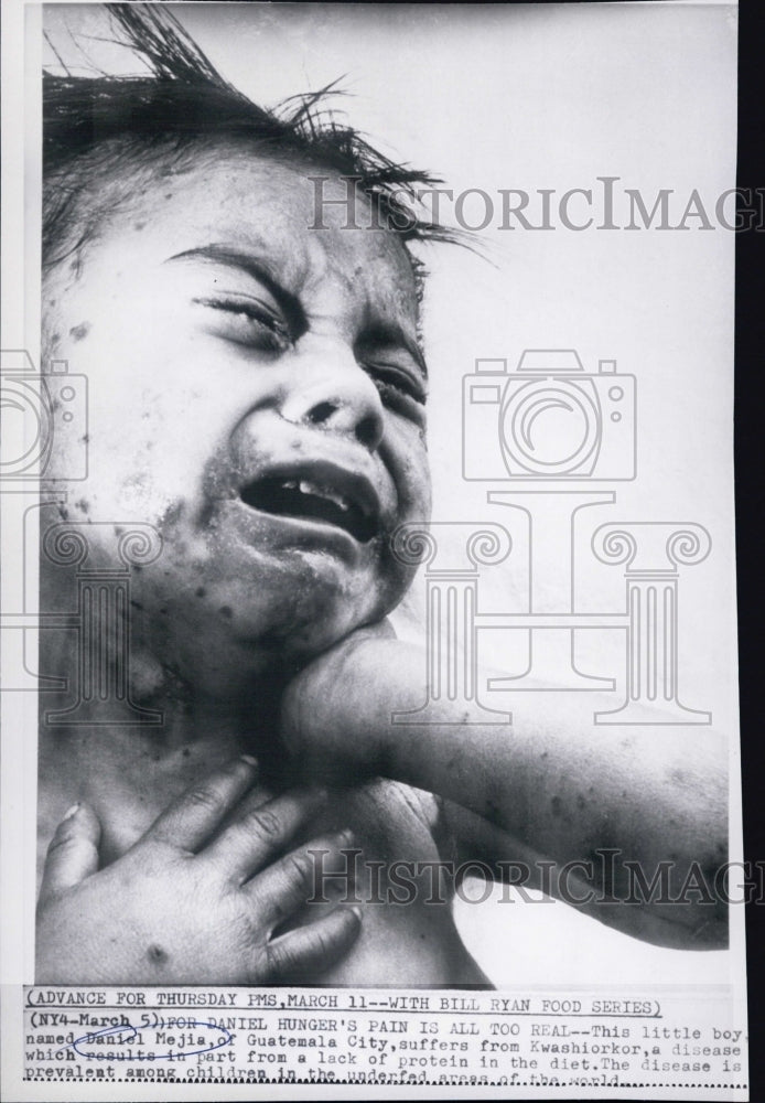 1965 Press Photo Daniel Mejia Child Hunger Guatemala City Kwashiorkor Disease - Historic Images