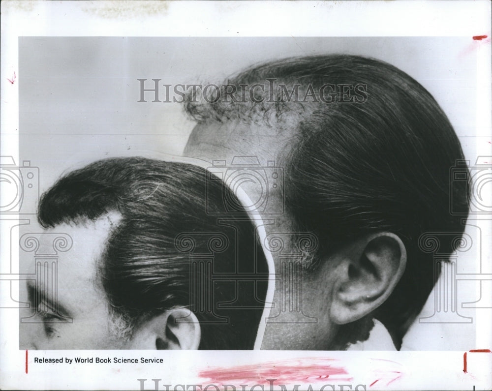 1970 Press Photo Hair Transplant - Historic Images