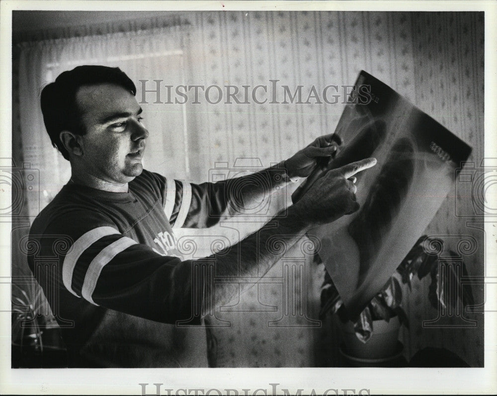 1983 Press Photo Faragi shows off x-rays of his chest after operation - Historic Images