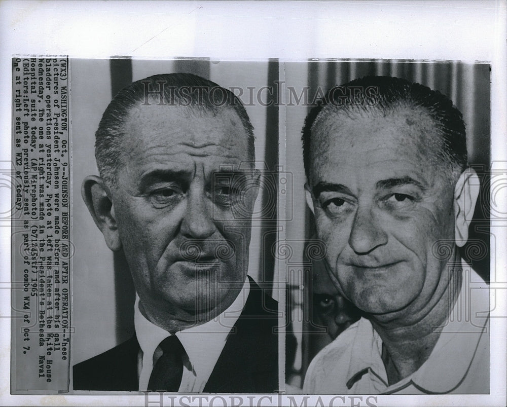 1965 Press Photo US President Lyndon B. Johnson, Gallbladder Surgery - Historic Images