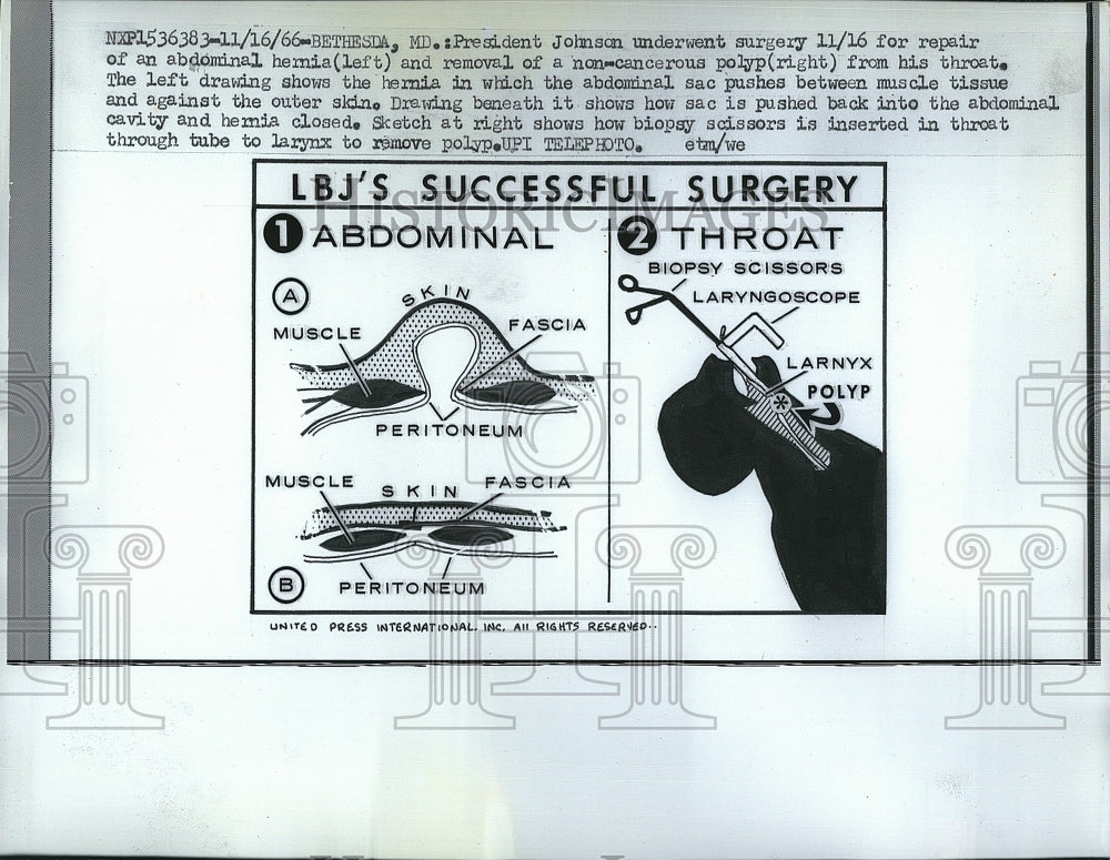 1966 Press Photo Diagram Of Lyndon B. Johnson Hernia Surgery, Polyp Removal - Historic Images