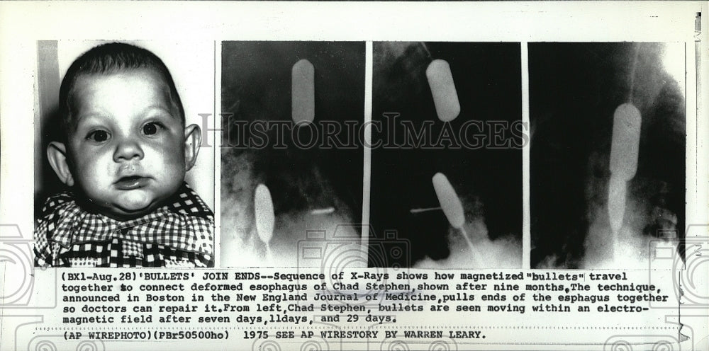 1975 Press Photo Chad Steven and x-rays to fix his esophagus - Historic Images