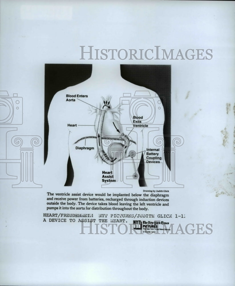 Press Photo The ventricle assist device would be implanted below the diaphragm-Historic Images