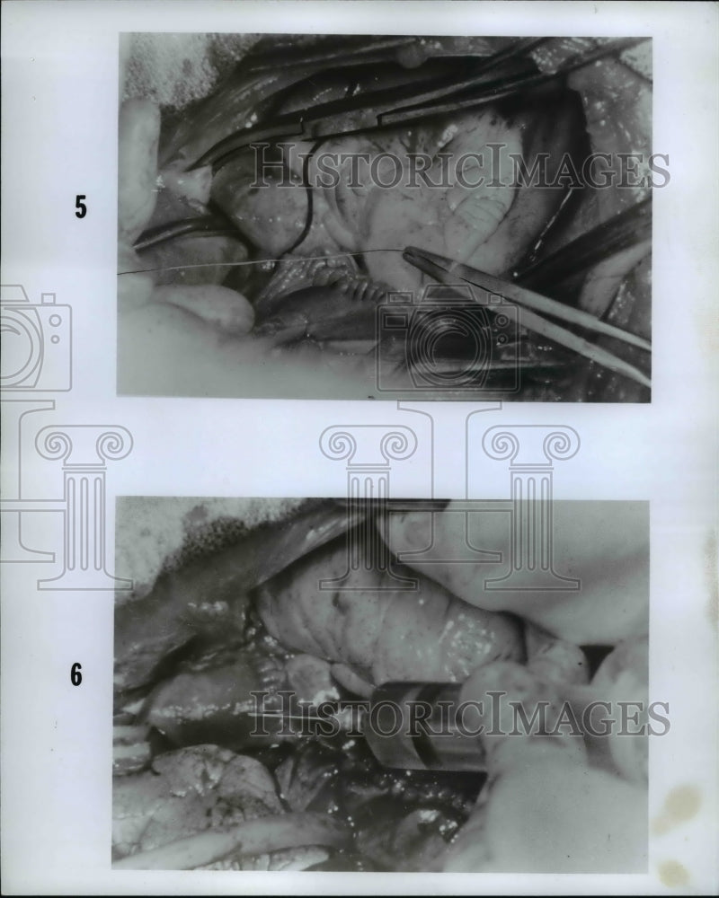 1968, Heart Transplants - Historic Images