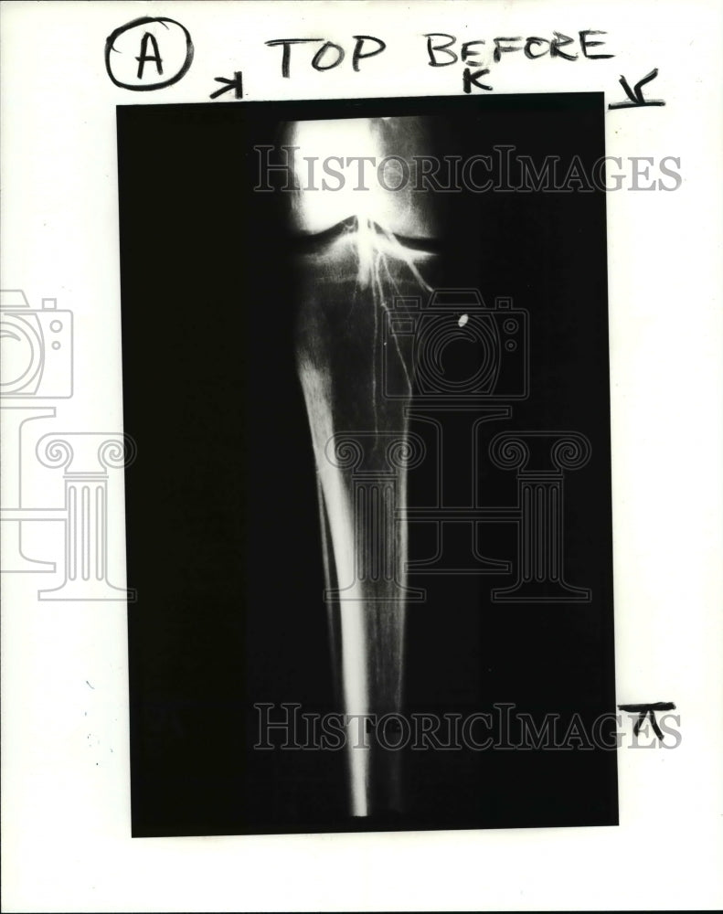 1985 Press Photo Leg X Rays - cvb11373 - Historic Images