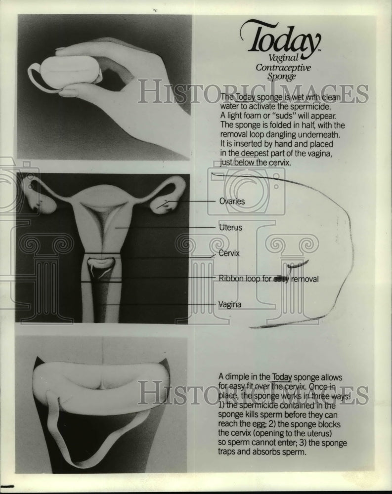 1984 Press Photo Vaginal Contraceptive Sponge poster - cvb27546 - Historic Images