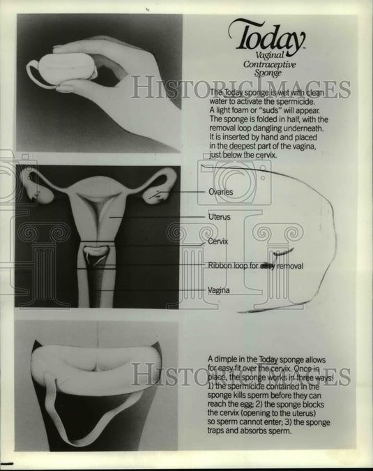 1984 Press Photo Vaginal Contraceptive Sponge poster - cvb27546 - Historic Images
