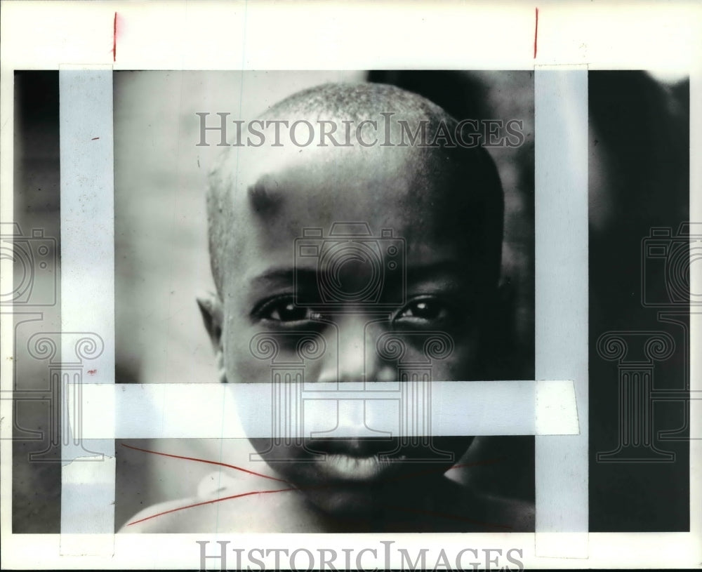 1985 Press Photo Forehead of an East African boy w/ nodule containing worms - Historic Images