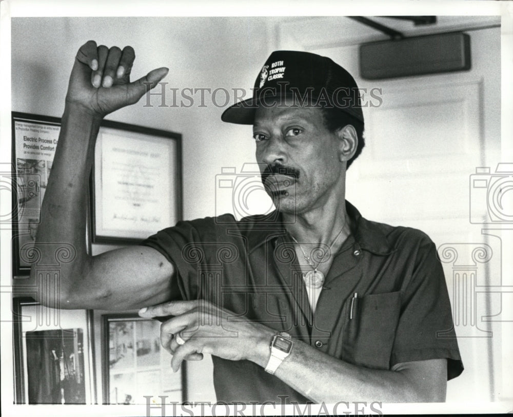 1982 Press Photo John Hardaway shows shots that hit him in the arm - cvb33117 - Historic Images