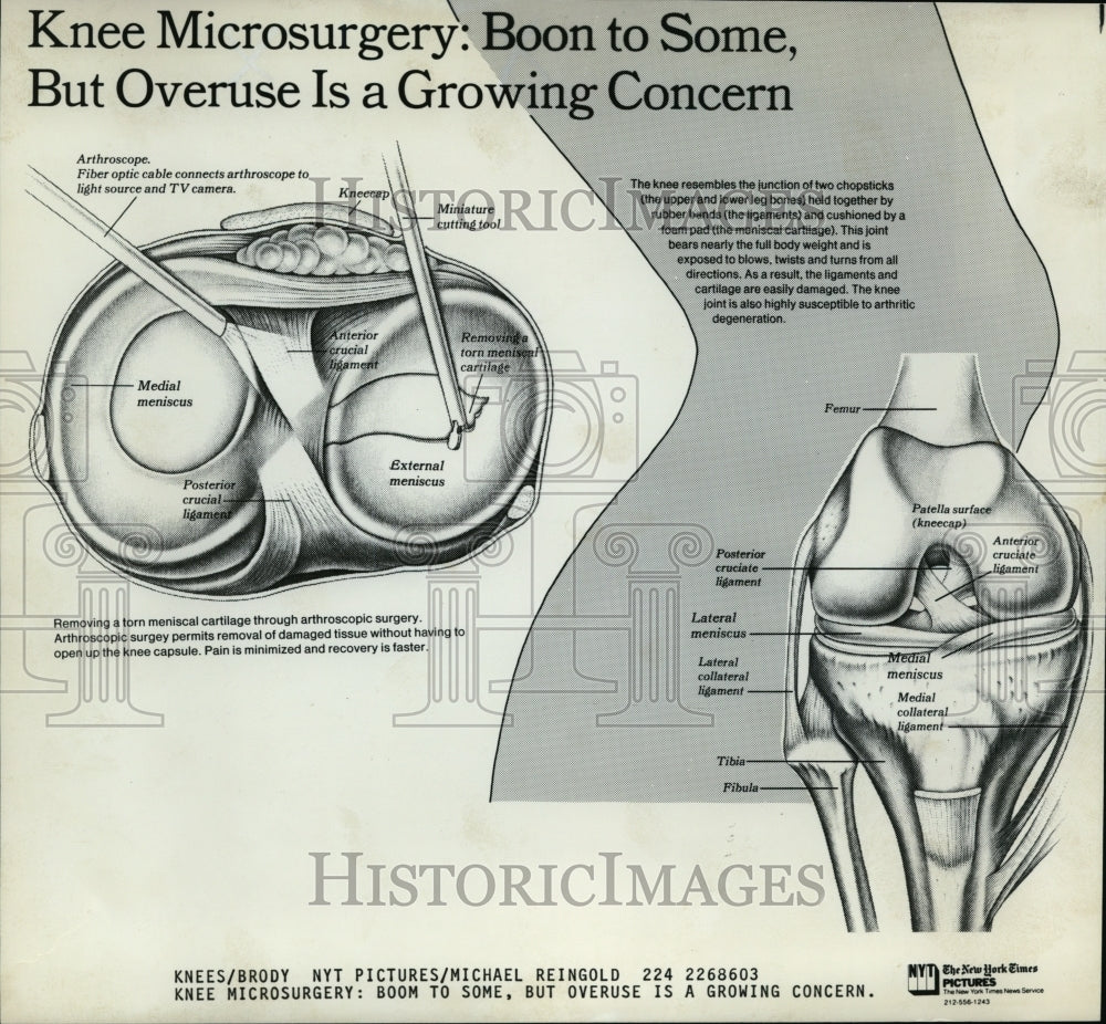 1987 Press Photo Knee Microsurgery Boon to some but overuse is a growing concern - Historic Images