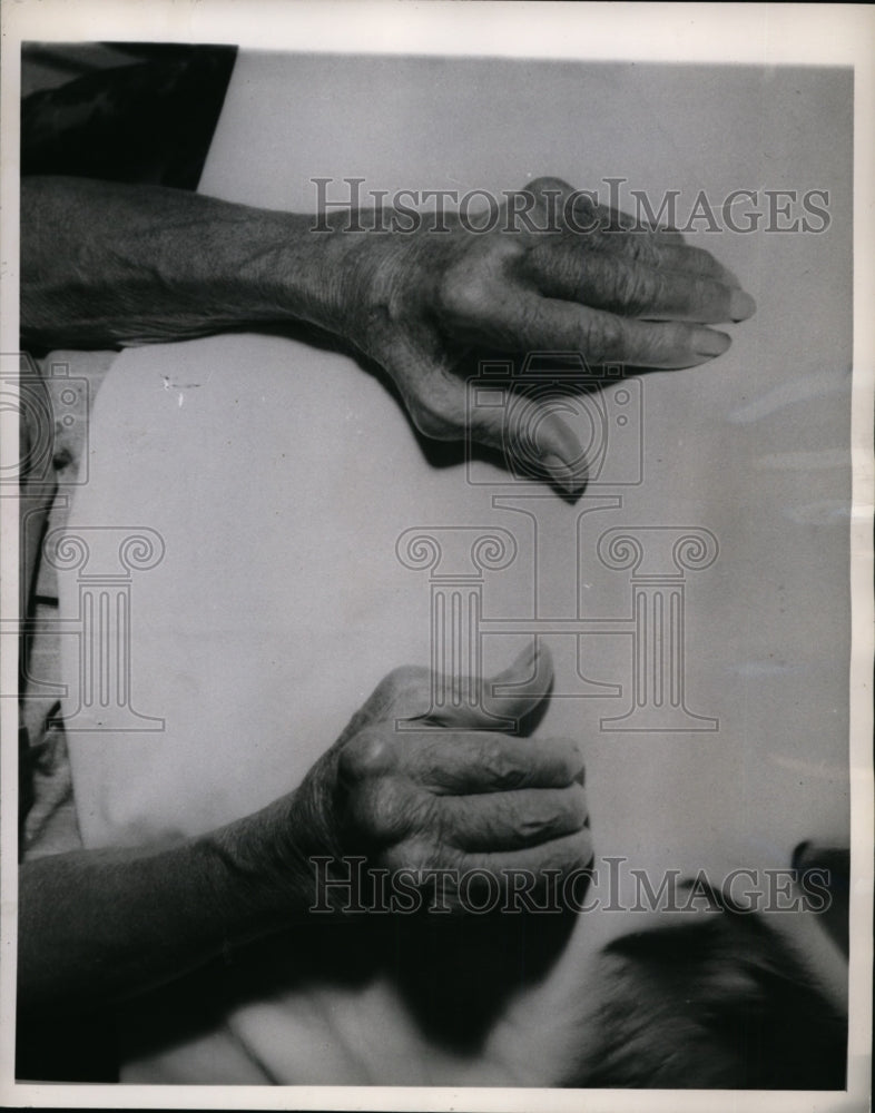 1946 Press Photo Here is a pair of hands crippled by Arthritis - cvb37590 - Historic Images